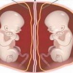 матка при беременности двойней