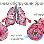 Механизм обструкции бронхов