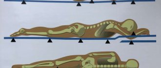 места появления пролежней локализация пролежней фото