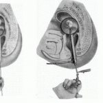 Методики удаления полипа в кишке