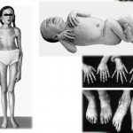 Methods for diagnosing and treating joint hypermobility