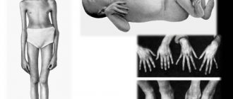 Методы диагностирования и лечения гипермобильности суставов