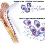 миелома продолжительность жизни