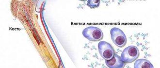 myeloma life expectancy