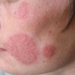 microsporia of smooth skin