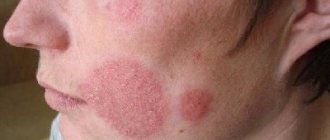 microsporia of smooth skin