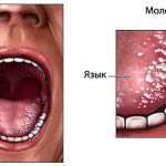 Молочница у ребенка во рту: симптомы и лечение медикаментами и народными средствами: содой, кандидом, зеленкой, медом. Когда проходит