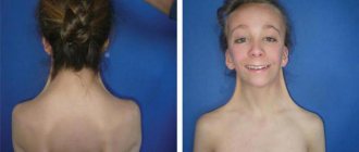 monosomy in girls