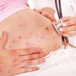 On what parts of the body does rash most often occur during pregnancy?