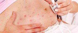 On what parts of the body does rash most often occur during pregnancy?