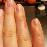 небольшой ожог