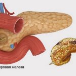 Necrosis of pancreatic tissue