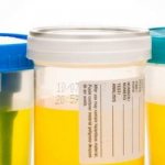 What can a three-glass urine sample tell us?