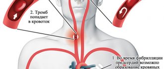 Blood clot formation in the left atrium leads to stroke