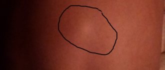 Общая информация о болезни