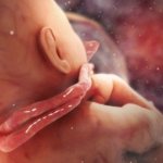 обвитие пуповиной