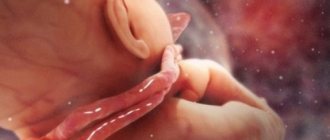 umbilical cord entanglement