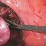 Обязательно ли удалять полипы в кишечнике