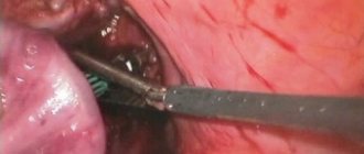 Is it necessary to remove polyps in the intestines?