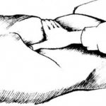 Определение симптома Мерфи