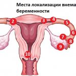 Определить внематочную беременность в домашних условиях. Признаки, симптомы