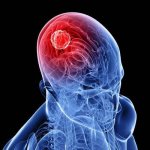 опухоль в мозгу