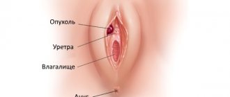 Tumor of the vulva