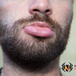 Опухший укус осы