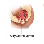 Uterine prolapse after childbirth