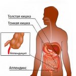 осложнения после аппендицита симптомы