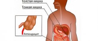 осложнения после аппендицита симптомы