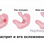Complications of gastritis