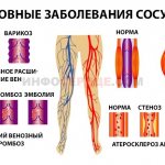 Main vascular pathologies