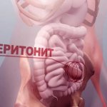 Острый перитонит