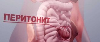 Острый перитонит