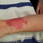 Ожог химикатами