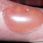 Ожог второй степени