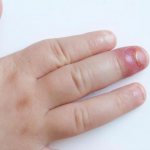 panaritium of the middle finger of a child’s hand, redness and swelling