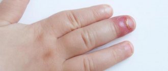 панариций среднего пальца руки у ребенка, покраснение и припухлость