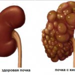 Parenchymal cyst (left and right) of the kidney: what is it, symptoms