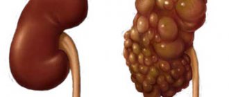 Parenchymal cyst (left and right) of the kidney: what is it, symptoms