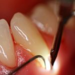 Пародонтит: симптомы, причины, лечение, профилактика