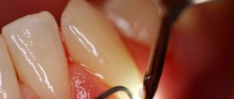 Periodontitis: symptoms, causes, treatment, prevention