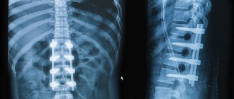 Spinal fracture
