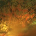 Пигментная абиотрофия сетчатки