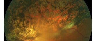 Retinal pigment abiotrophy