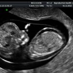 fetus on ultrasound