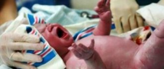 Pneumonia due to ingress of amniotic fluid