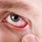 why do my eyes turn red