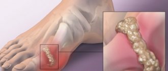 Gout